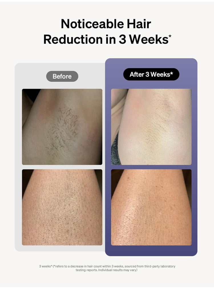 Ulike Laser Hair Removal for Women and Men, Air 3 Ice-Cooling IPL Device Hair Removal for Nearly Painless & Long-Lasting Results, 3 Modes & Auto Flashing for Fast Full Body Hair Removal from Home